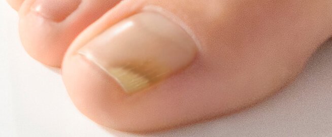 Nagel svamp tånagel missfärgad