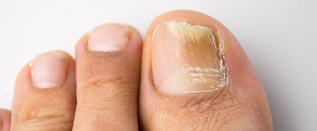 Nagelsvamp tjock tånagel